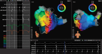Imagen: El sistema de Mapeo Rhythmia (Fotografía cortesía de Boston Scientific).	